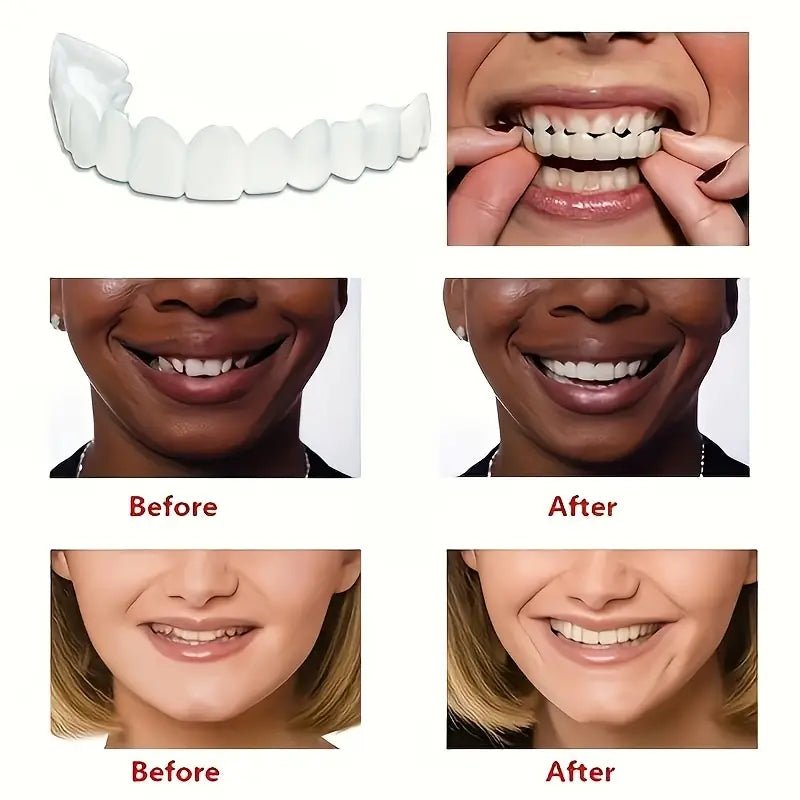 Snap-On Smile Moldable False Teeth Veneers with Artificial Braces Kit for Men & Women – Temporary Cosmetic Dental Solution