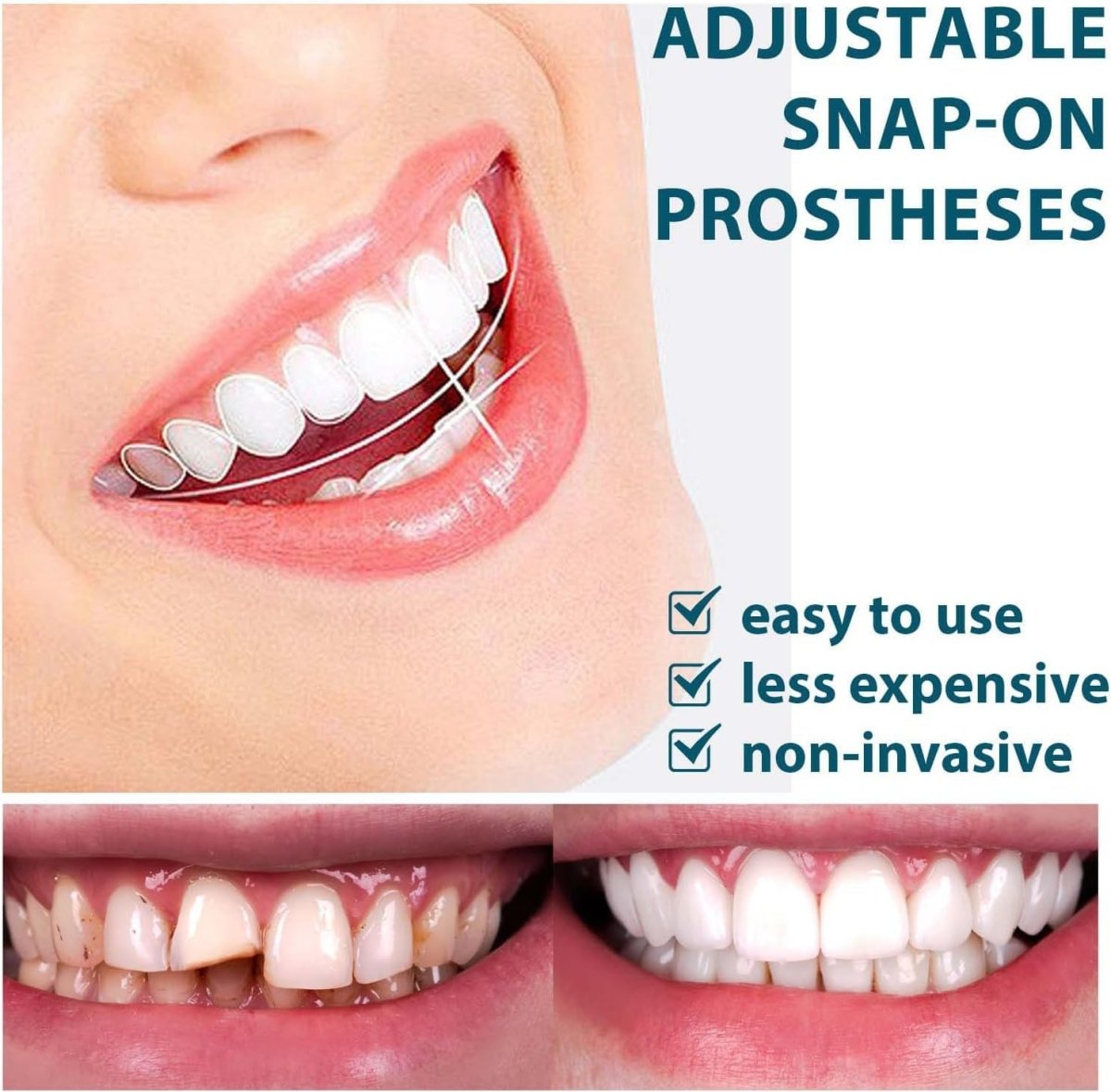 Snap-On Smile Moldable False Teeth Veneers with Artificial Braces Kit for Men & Women – Temporary Cosmetic Dental Solution